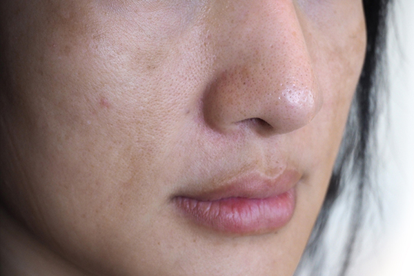 general queries about melasma